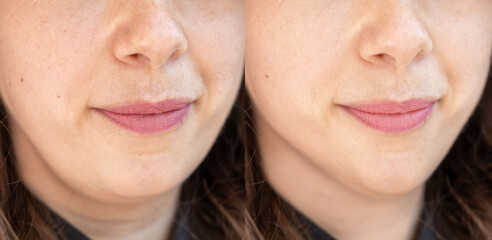 Young woman chin close-up before and after face contour correction, aesthetic beauty treatment,...