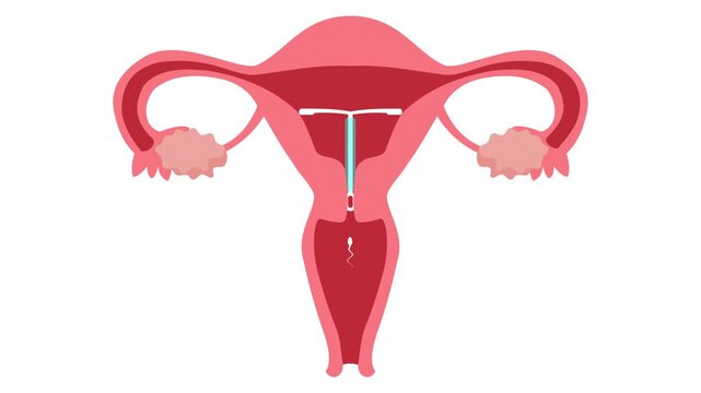 Anatomy of an Intrauterine Contraceptive Device (IUD) Inserted in a Woman's Uterus to Prevent Pregnancy