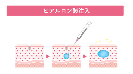 ヒアルロン酸注入
