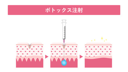 ボトックス注射　しわ
