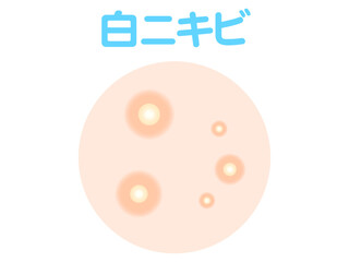 	白ニキビのイラスト素材