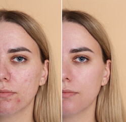 Before and after beauty treatment. Photo of young woman on beige background, collage