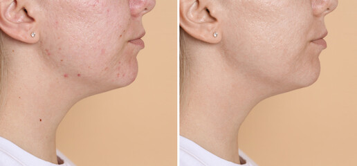 Before and after beauty treatment. Photo of young woman on beige background, collage