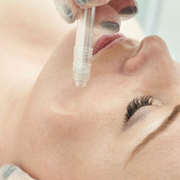 Close-up of female caucasian adult receiving facial treatment with dermapen for skin rejuvenation.