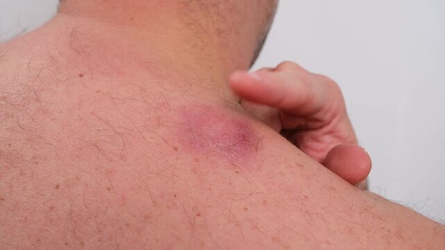 Close up view from behind of a shirtless man touching a large red atheroma on his shoulder, a benign tumor requiring medical attention, on a clean and bright white background