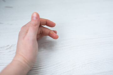 Finger Burn Injury after Using Hot Glue Gun in Craft Project