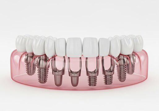Full Dental Prosthesis with Implants, White Teeth, Pink Acrylic Base on White Background