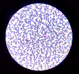 Leukemia cells, Neutrophil , Lymphocyte in blood smear.