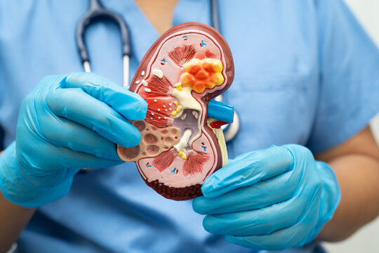 Chronic kidney disease, doctor with model for treatment urinary system, urology, Estimated glomerular filtration rate eGFR.