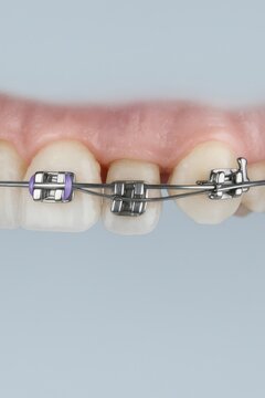 orthodontic braces, dental braces, orthodontic treatment, close up teeth, dentistry, metal brackets, orthodontics, teeth alignment, dental wire, dental care, dental health, orthodontic correction, tee