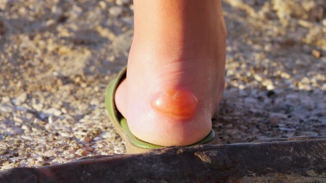 Huge Fluid Filled Blister on a Woman's Heel - Close Up