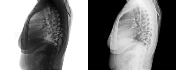 Lateral View Dorsal Spine X-Ray of Vertebral Alignment and Skeletal Anatomy for Lower Back Pain