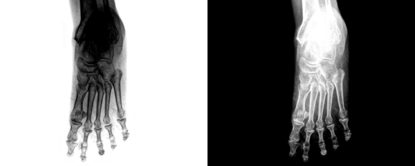 Anterior View Foot X-Ray Radiograph Showing Skeletal Structure and Bone Alignment