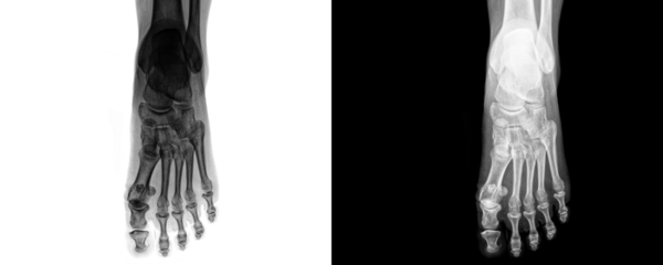 Medical Radiograph of Foot Anterior View Demonstrating Bone Structure and Skeletal Alignment