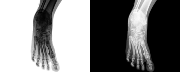 Anterior Projection X-Ray of Human Foot Showing Detailed Skeletal Framework and Bone Anatomy