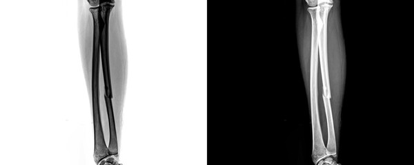 Anterior View Forearm X-Ray Showing Skeletal Anatomy and Bone Alignment for Fracture Diagnosis