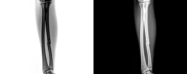 Anterior View Forearm X-Ray Showing Skeletal Anatomy and Bone Alignment for Fracture Diagnosis