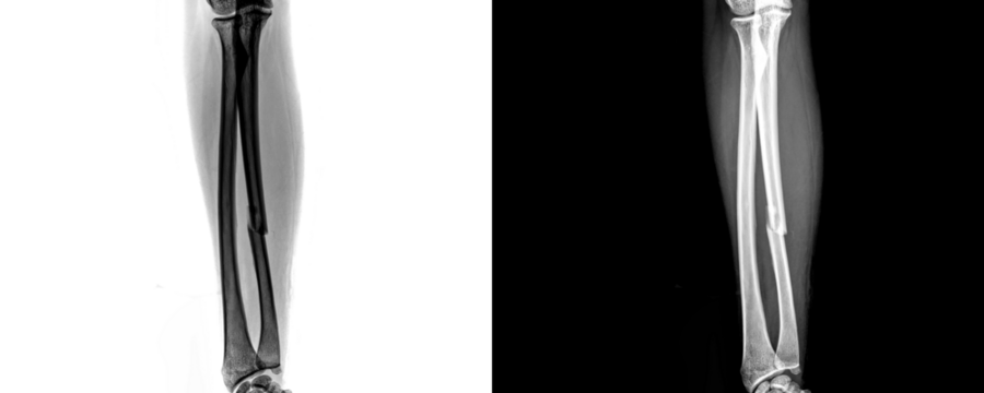 Anterior View Forearm X-Ray Showing Skeletal Anatomy and Bone Alignment for Fracture Diagnosis