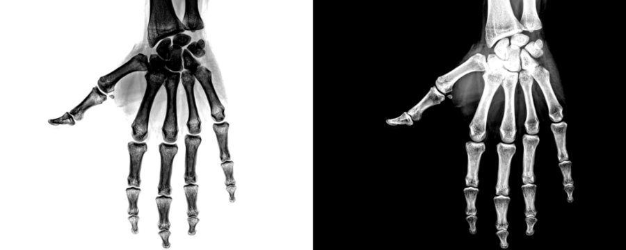 Anterior View Hand X-Ray Radiograph Showing Skeletal Anatomy and Bone Alignment for Medical Use