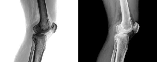 Medical X-Ray of Knee Joint Lateral View of Skeletal Framework and Bone Anatomy for Arthritis