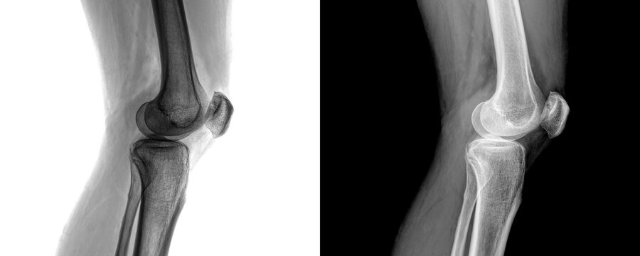 Medical X-Ray of Knee Joint Lateral View of Skeletal Framework and Bone Anatomy for Arthritis