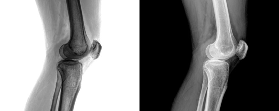 Medical X-Ray of Knee Joint Lateral View of Skeletal Framework and Bone Anatomy for Arthritis