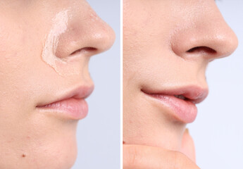 Obraz premium Woman with dry skin on face before and after moisturizing treatment, closeup. Collage of photos