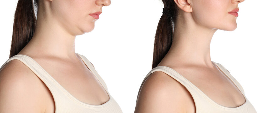 Woman with double chin before and after surgery, closeup. Collage of photos on white background