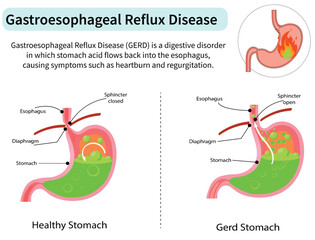 Gastroesophageal Reflux Disease (GERD) or Heartburn and Acid Reflux Illustration on White Background. Medical Diagram