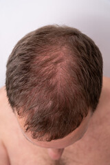 Obraz premium Adult man suffering from head hair loss and male pattern baldness, showing thinning hair and visible scalp from an overhead view, representing a common health and aging concern