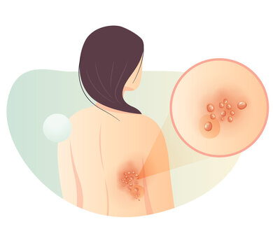 One Side Rashes on the Back - Herpes zoster - Shingles - Stock Illustration