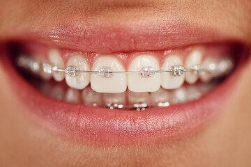 Obraz premium Close up of a woman mouth with braces.