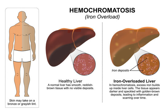 Hemochromatosis (Iron Overload) Flashcard Illustration