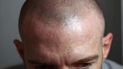 Close-up of a bald head with tiny dot scars on the scalp from a hair transplant. Concept Close-up scalp with hair transplant scars, Bald head portrait, Hair restoration microdots