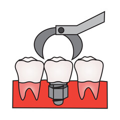 Molar Dental Implant Installation