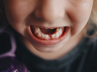 A child's first lost tooth. A jaw with a missing tooth in the lower jaw. Pediatric dentistry.