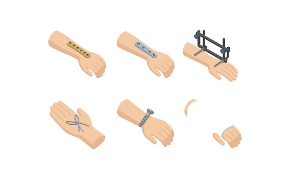 isometric icon items isolated on white background wrist fracture Colles plate wrist fracture Smith' plate wrist fracture external fixator wrist fracture lunate wiring wrist fracture