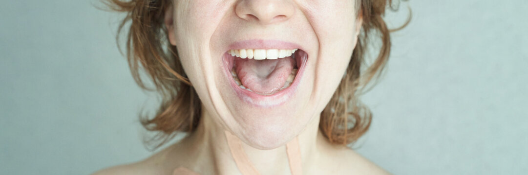 Caucasian female adult showing mouth with missing teeth and open smile.