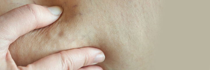 Close-up of female skin showing cellulite dimples with finger pinching area on thigh surface.
