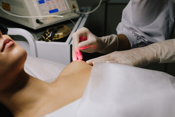 Laser therapy eliminates nevi, papillomas, and other cutaneous lesions. Laser excision of benign neoplasms on the body. Laser removal of nevi and fibromas close-up.