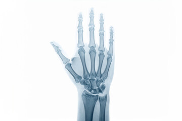 x-ray of a hand