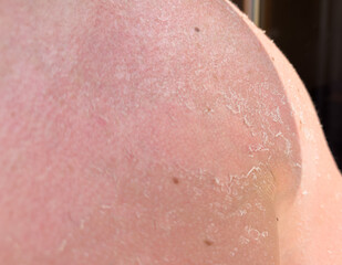 Fototapeta premium Sunburn, peeling skin, burns, skin problem, vertigo, health, summer and sun. High quality