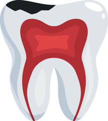 Cross section of a molar showing decay, cavity, and pulp damage, emphasizing dental health issues