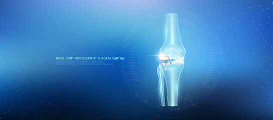 Knee joint replacement partial. Prosthetic implant integrated into the leg bone socket. Orthopedic technology artificial joint surgery in a transparent anatomical. Medical health care vector.