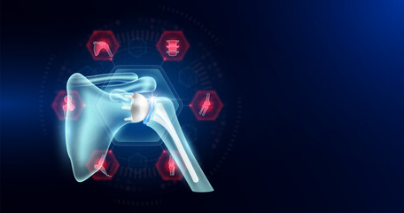 Shoulder replacement surrounded by arthritis icons. Artificial joint surgery, prosthetic implant integrated into the bone. Orthopedic technology medical. Empty space for text. Vector EPS10.