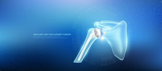 Shoulder joint replacement. Prosthetic implant integrated into the upper arm bone socket. Orthopedic technology artificial joint surgery in a transparent anatomical. Medical health care vector.