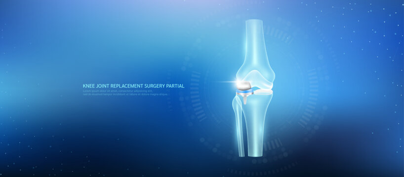 Knee joint replacement partial. Prosthetic implant integrated into the leg bone socket. Orthopedic technology artificial joint surgery in a transparent anatomical. Medical health care vector.