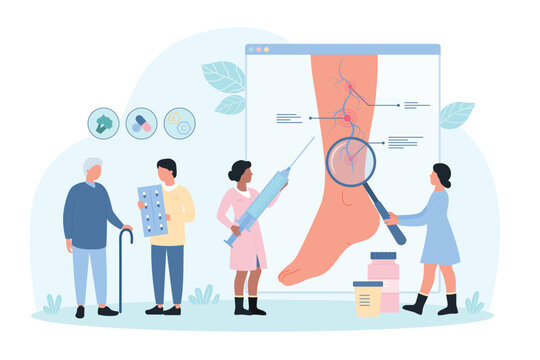 Varicose, vein thrombosis diagnosis and treatment on phlebology examination vector illustration. Cartoon tiny people phlebologists diagnose chronic vascular disease of leg veins with magnifying glass