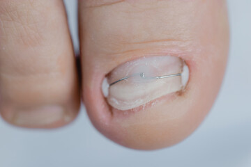 Closeup ingrown toenail after Restoration of with titanium bracket nail shape, medical podiatrist treatment