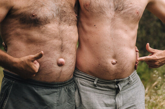 Photograph, portrait of a family of adult men, two people, father and son, with umbilical hernias inherited. Concept of illness.